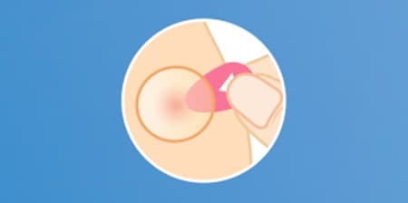 ÉTAPE 2 : Appliquez le patch boutons en orientant la languette rouge vers la peau
