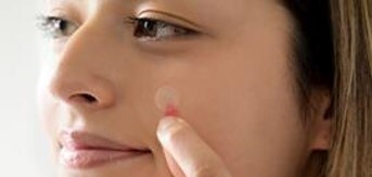 Gros plan de peau près de l’oreille, cheveux bruns, petite tache rouge et patch Nexcare anti‑acné, fond clair.
